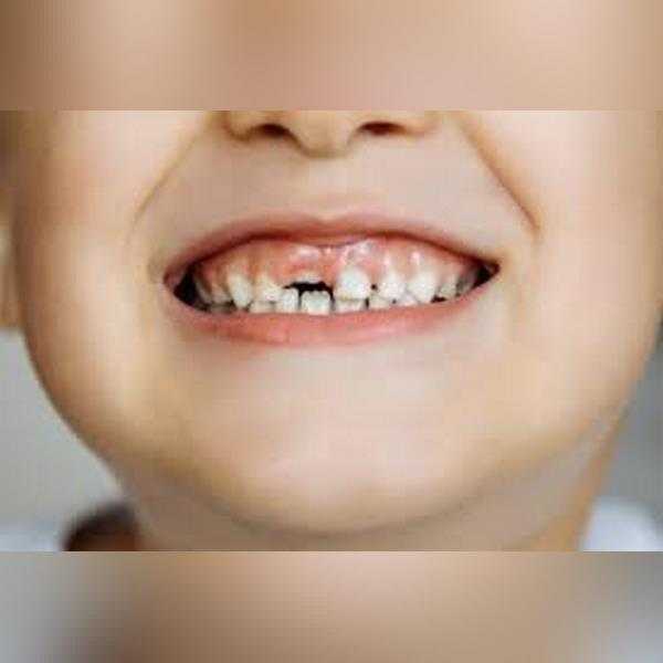 اهمیت دندان شیری رویش دندان دائمی پشت دندان شیری زمان افتادن دندان شیری کشیدن دندان شیری زودتر از موعد