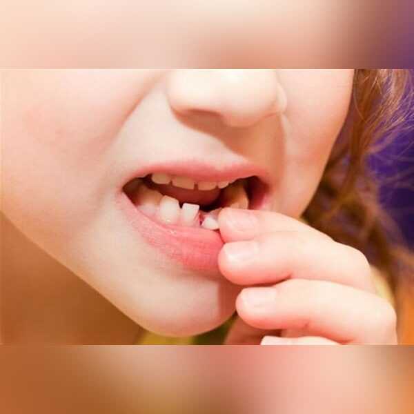 دندان شیری کودکان چگونه بفهمیم دندان شیری است دندان شیری در بزرگسالی فیلم دندان شیری