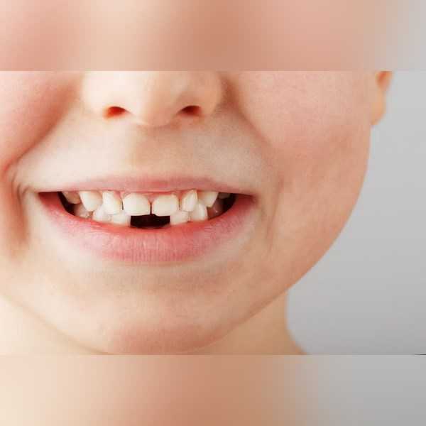 دندان‌های کودکان