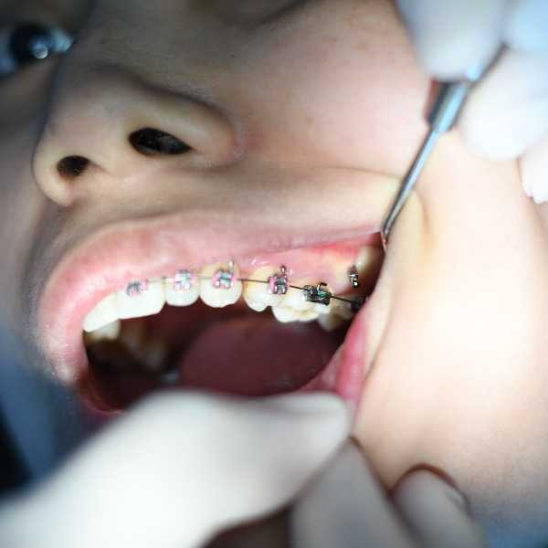 عوارض دندان عقل عوارض ماندن ریشه دندان در لثه خرابی دندان عقل استخوان لثه بعد از کشیدن دندان عوارض عفونت دندان علائم پوسیدگی دندان درد دندان عقل نهفته